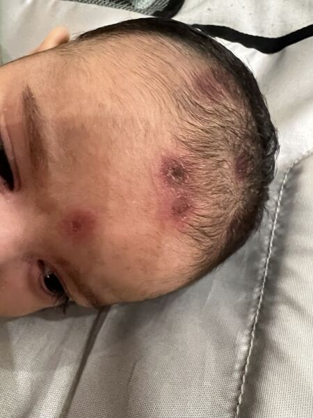 10 week old baby- unidentified cause of rashes