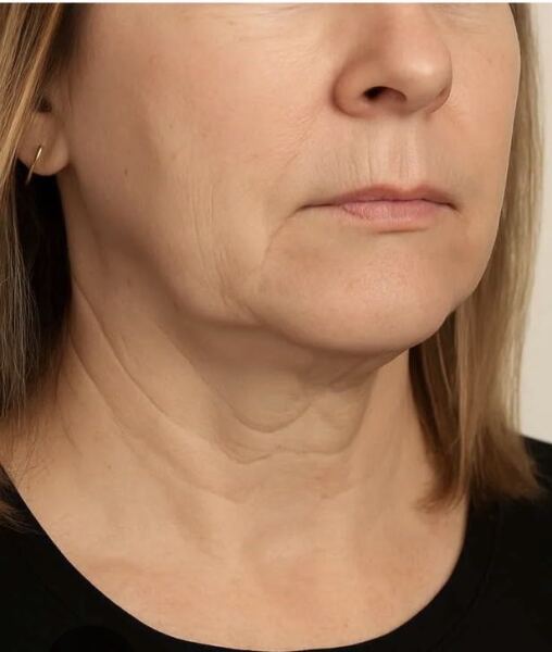 Melting face