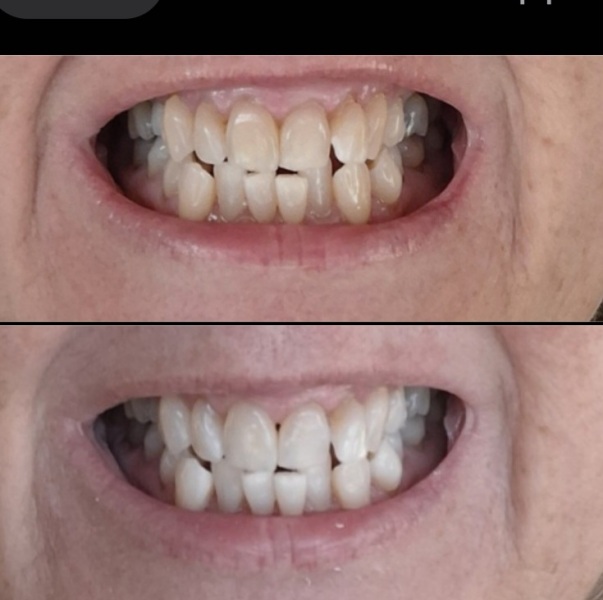 Confused about teeth whitening