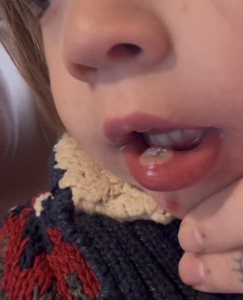 Advice needed - toddler badly bit lip