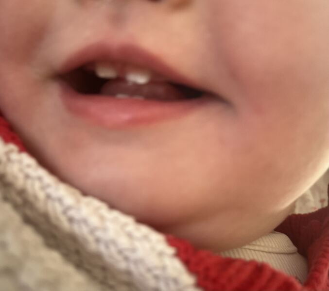 White spots appeared on 11mo teeth