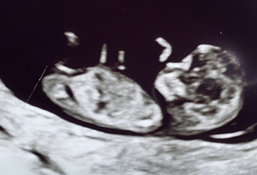 11 weeks scan photo - boy or girl?