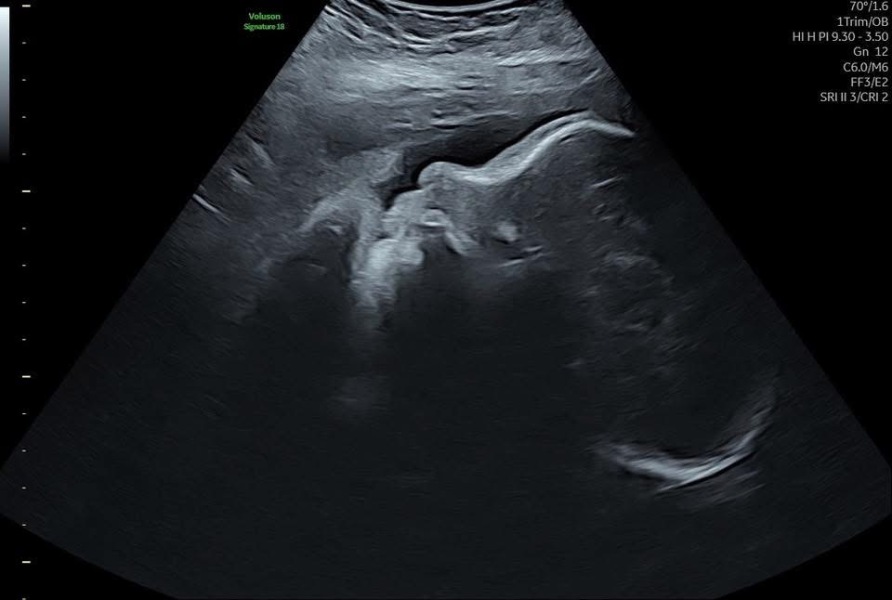 Gender guesses but only have 31 week 3D scan
