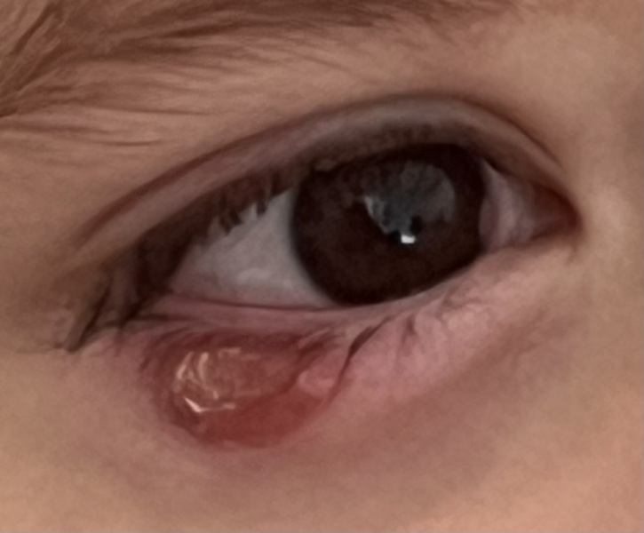 3 year old chalazion not going away been over 3 months