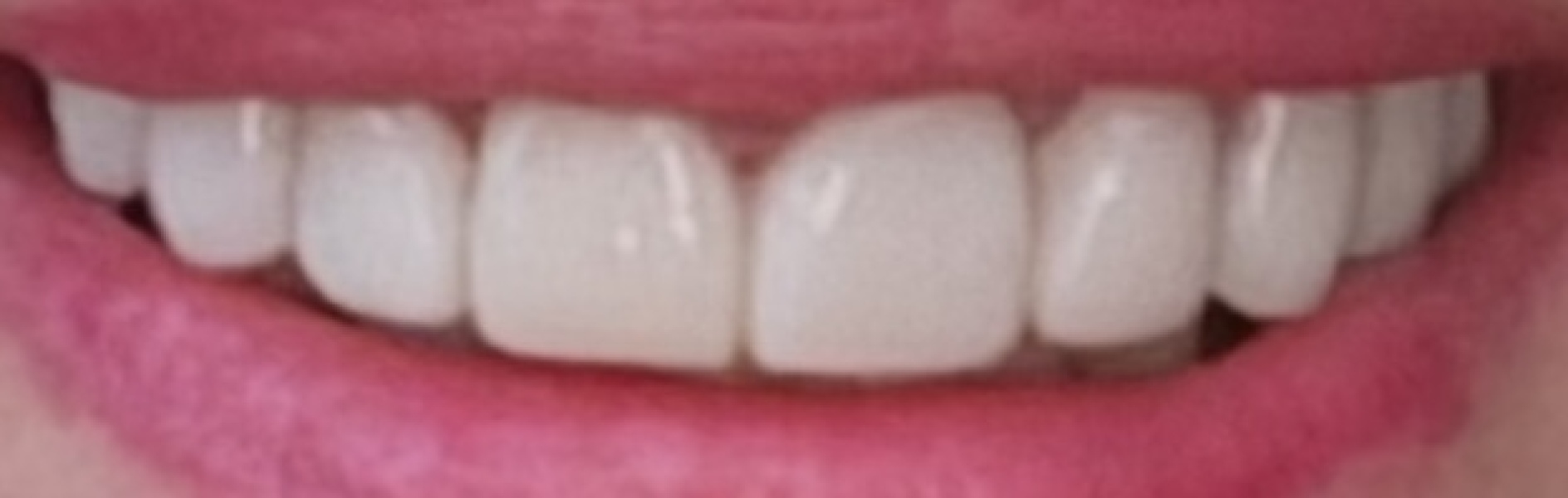 Not happy with new veneers