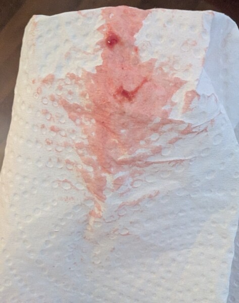 *trigger warning photos* 10dpo bleeding