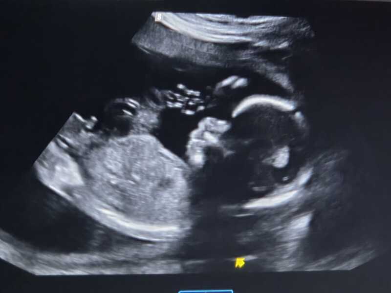 Please help me find out baby's gender