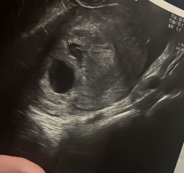 Possible twin pregnancy?