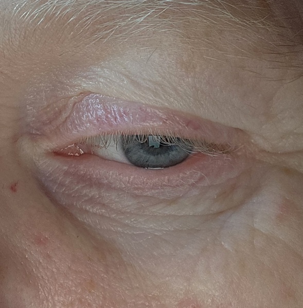 Sagging skin above my eye lids.