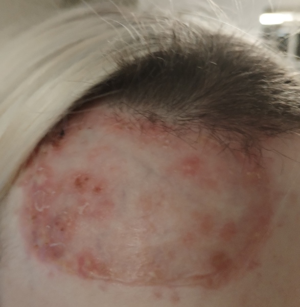 Daughter in hospital - full thickness burns
