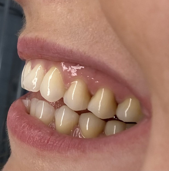 My teeth are awful and I’m scared to go to the dentist!! Pic attached.