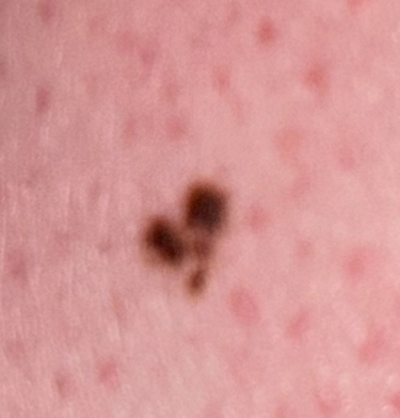 Atypical mole - So worried