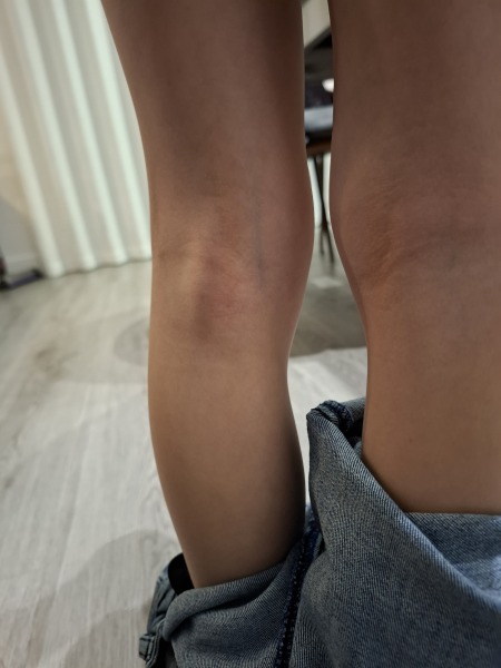 Would you worry if your 7yo had these swellings?