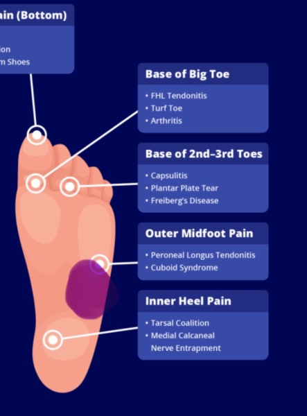 Foot pain - runners