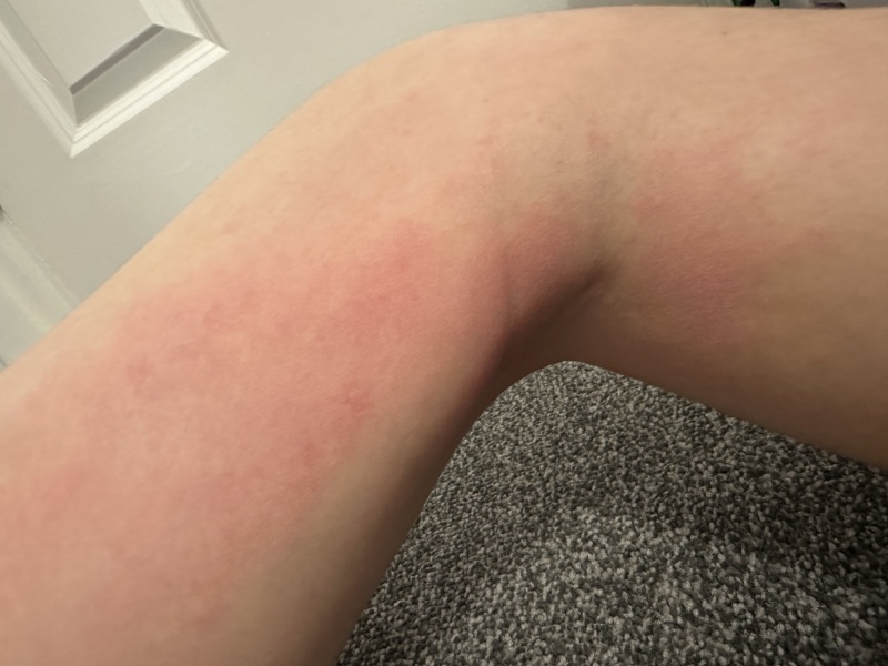 To ask people with experience if this is eczema?