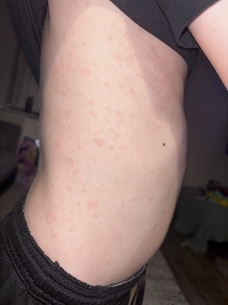 Is this chicken pox?