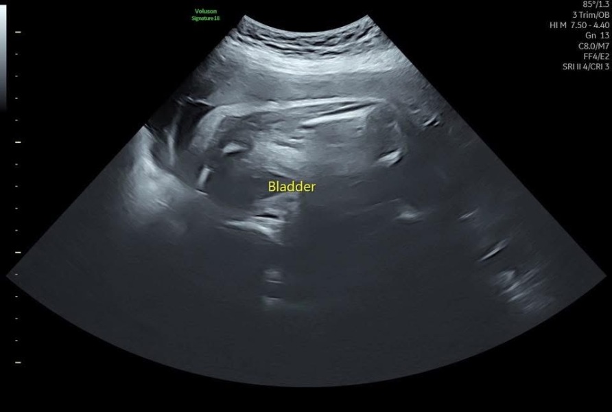 Gender guesses but only have 31 week 3D scan