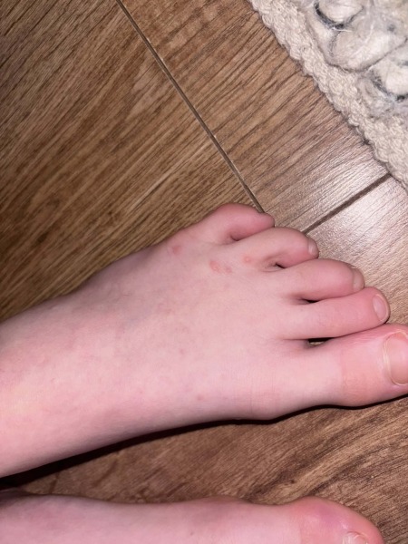 Is this chicken pox?