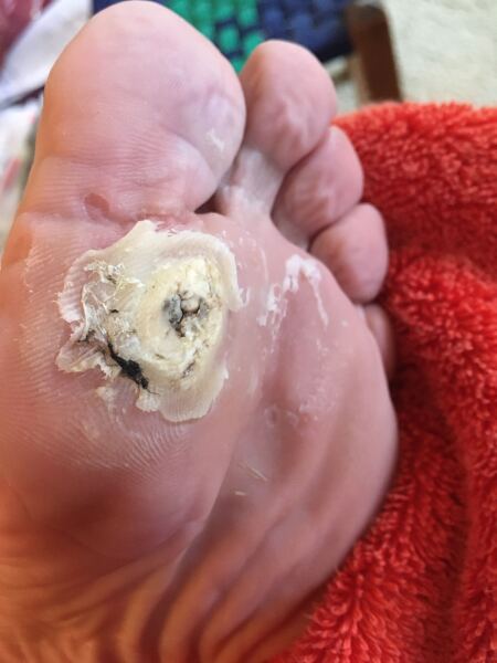 How do I get rid of this verucca - warning, picture included