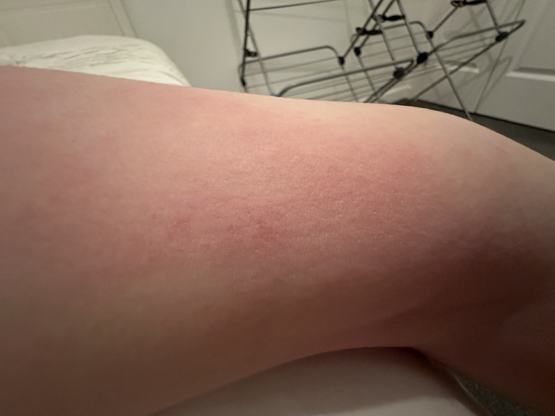 To ask people with experience if this is eczema?