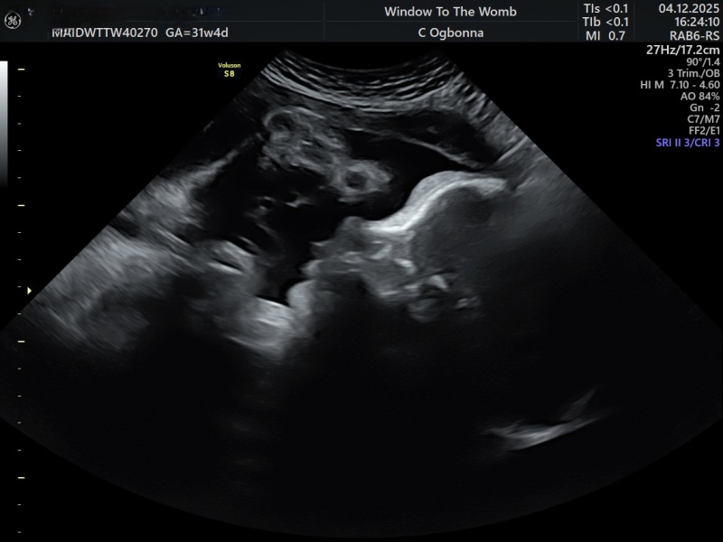 Downsynodrome Pregnancy Concerns