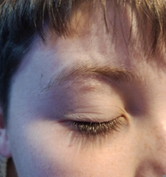 Pea sized lump under eye brow for months.