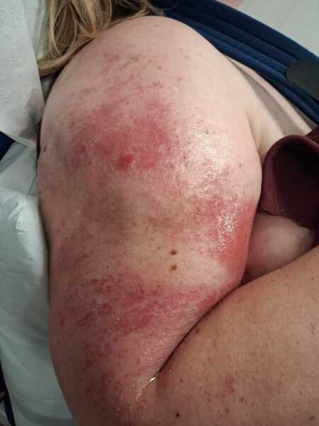 Broken arm and dont trust Dr's after they've consistently messed up.