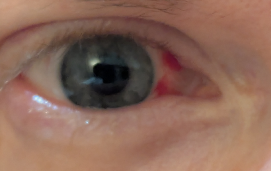 Red eye