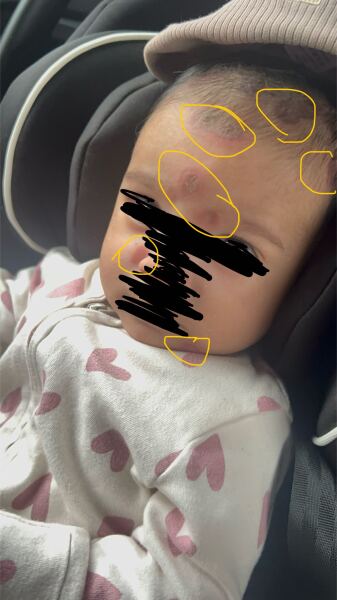 10 week old baby- unidentified cause of rashes