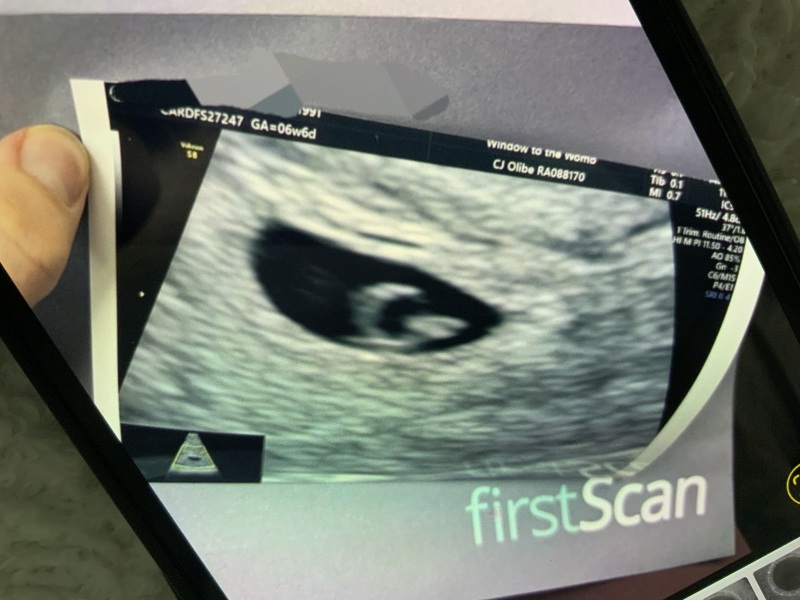 Ramzi theory guess transvaginal