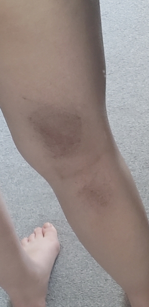 Mysterious dark patch of skin behind legs 14 weeks