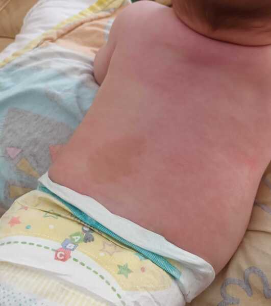 Birthmark experiences