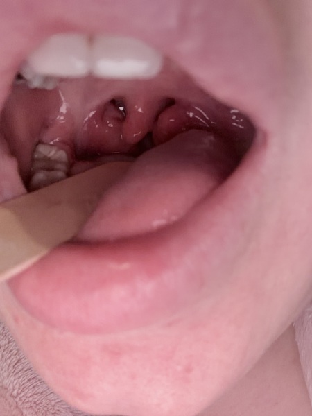 Tonsillitis or quinsy?