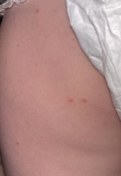 Does this look like chickenpox?