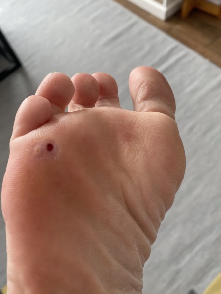 How do I get rid of this verucca - warning, picture included