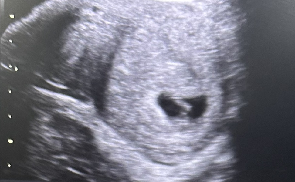 Missed twins at early scan ?