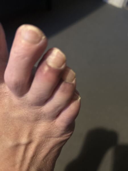 My poor toes - A&E or not
