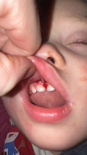 17 month old fell and hit face