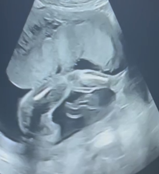 20 week potty shot. What’s your guess- girl or boy?