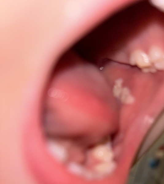 What is this white bit in my 4YO cheek?