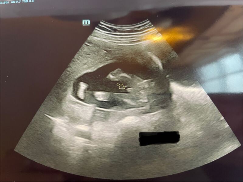 Scan at 16+6. This is definitely a boy, right? 💙