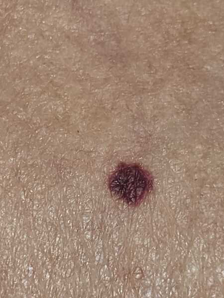 Is this a blood blister or.....