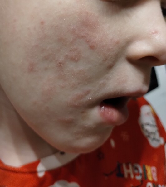 What is this rash? Eczema?