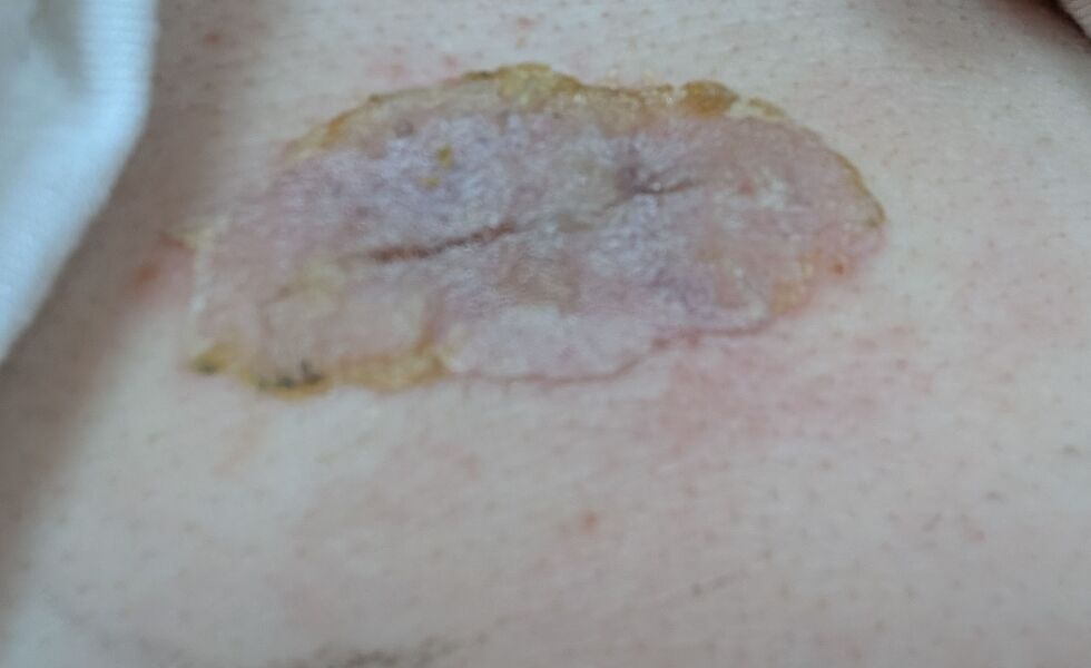 Surgical glue pic a bit gross