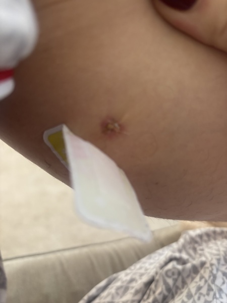 Does this look infected ? Any nurses about