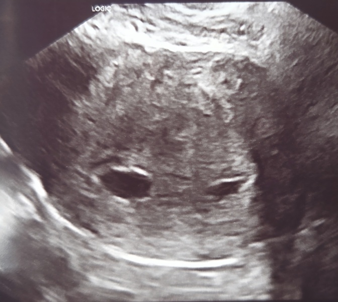 5-6 week internal ultrasound