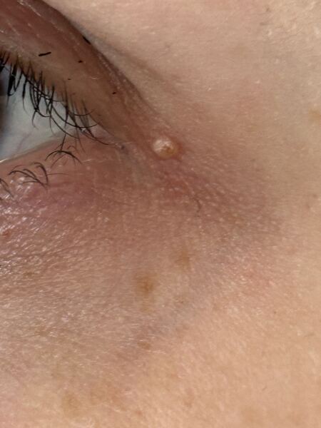 Growth near eye