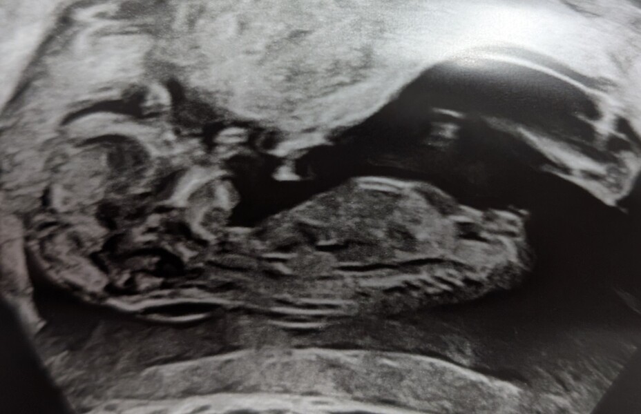11 weeks scan photo - boy or girl?