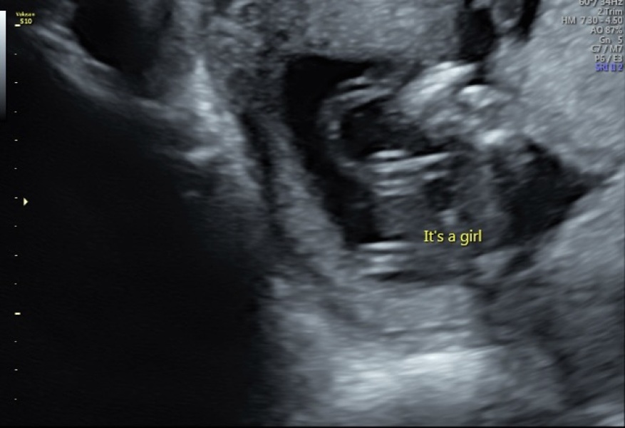Early gender scan, is this right?