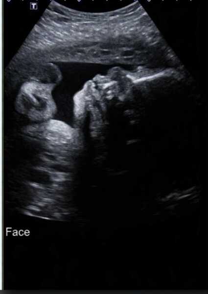 When did they induce you having Cholestatis